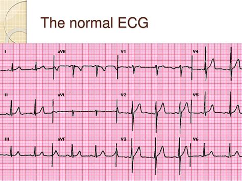 normal ecg sample|what are normal ecg results.